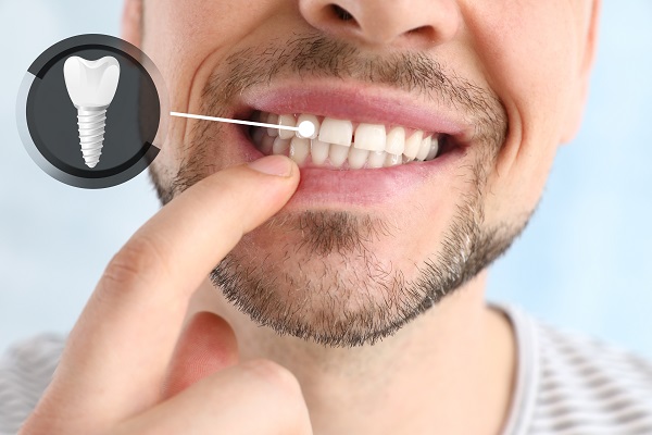 Commonly Asked Questions About Single Tooth Dental Implants